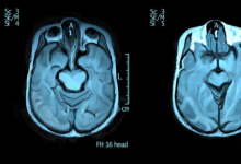 研究人员发现自闭症患者的大脑更加对称