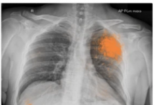 谷歌详细介绍了可以对人类胸部X射线进行准确分类的AI