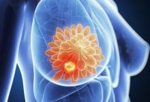 新的Google AI工具比放射科医生能更好地检测乳腺癌