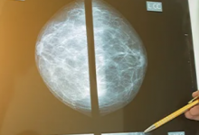 研究表明与放射科医生相比Google AI系统可以更好地发现乳腺癌的早期迹象