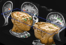 MRI扫描仪针对神经成像的两个推动极限而构建