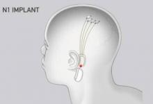 ElonMusk的Neuralink将在大脑中放入细线来控制设备
