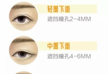 爱尔眼科眼整形专家提醒：眼睛睁不开？当心上睑下垂！