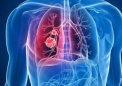 未满足的需求与肺癌患者较低的生活质量有关