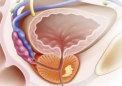 前列腺癌尿检确定预后良好的患者