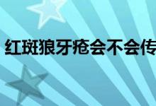红斑狼牙疮会不会传染（红疮狼斑会传染吗）