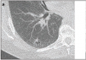 在后续肺癌筛查 CT 中检测到的结节中的癌症风险
