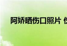 阿娇晒伤口照片 伤口有多严重什么情况