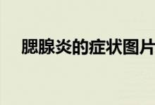 腮腺炎的症状图片大全（腮腺炎的症状）