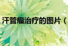 汗管瘤治疗的图片（汗管瘤的最佳治疗方法）