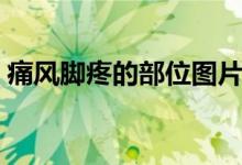 痛风脚疼的部位图片（痛风常见部位是哪里）