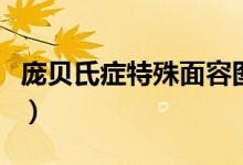 庞贝氏症特殊面容图片（庞贝氏症是什么疾病）